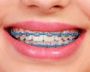 Are Power Chains Necessary For Straightening Teeth?