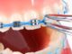 Caring For Your Teeth With Power Chain Braces