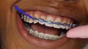 Common Questions About Braces Power Chains Answered
