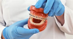 Everything You Need To Know About Power Chain Braces