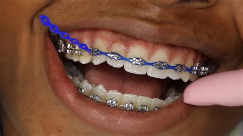 Exploring Alternative Options To Power Chain Braces