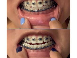How Power Chain Braces Affect Your Daily Life