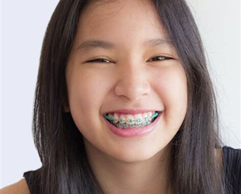 Inspiring Testimonials From Power Chain Brace Wearers