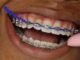 Lifestyle Changes To Consider With Power Chain Braces