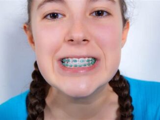 Long-Term Care For Teeth After Removing Power Chain Braces