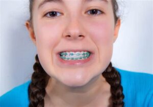 Maintaining Oral Hygiene With Power Chain Braces