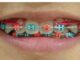 Power Chain Braces: A Comprehensive Guide For New Users