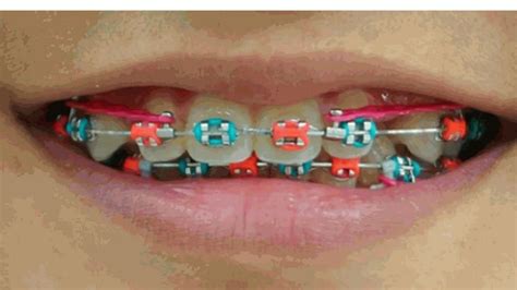 Power Chain Braces: A Comprehensive Guide For New Users
