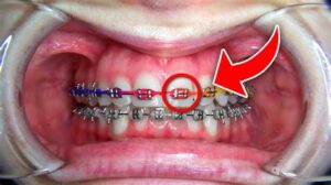 Power Chains: An Essential Tool For Orthodontists