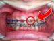 Power Chains: An Essential Tool For Orthodontists