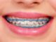 Power Chains And Their Impact On Your Smile