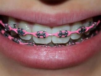 Power Chains Vs. Traditional Braces: What's The Difference?