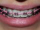Power Chains Vs. Traditional Braces: What's The Difference?