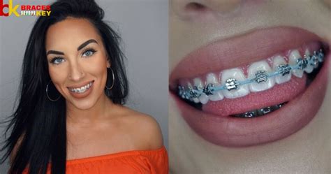 Success Stories: Before And After Power Chain Braces
