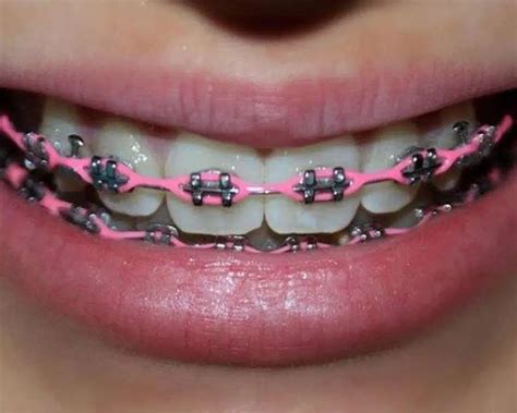 The Connection Between Power Chains And Teeth Alignment