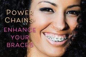 The Evolution Of Power Chains In Orthodontics
