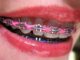 What Are Power Chains In Braces?