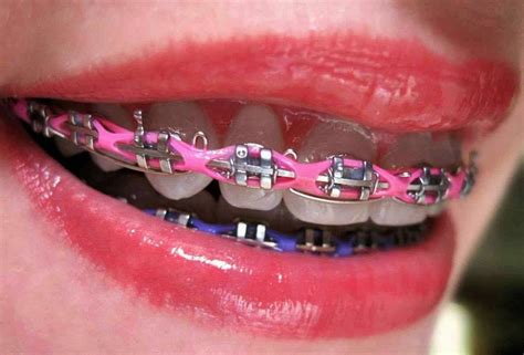 What Are Power Chains In Braces?