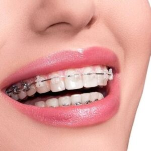 What To Expect During Your First Visit For Power Chain Braces