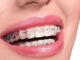 What To Expect During Your First Visit For Power Chain Braces